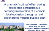 A dramatic “cutting” effect during retrograde percutaneous coronary intervention of a chronic total occlusion through an old degenerated venous bypass graft