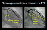 Using iFR and iFR Co-Registration to Improve Outcomes and Move Towards a Simplified Lesion-Level Assessment Tool