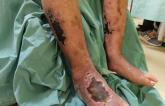 COMPASS Approach Helps With Leg Complications in Patients With PAD