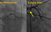 Delayed Coronary Obstruction After TAVR: Prevalence, Causes, and Solution Explored for Deadly Complication