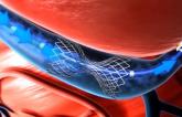 Positive Real-World Results for Coronary Sinus Reducer in Patients With Refractory Angina