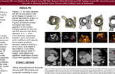 3D Printing and Computer Modeling to Predict Paravalvular Leak in Transcatheter Aortic Valve Replacement