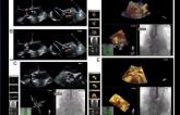 Echocardiographic Imaging for TAVR