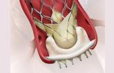 Valve-in-Valve TAVR: Mortality, Adverse Events Similar to Redo Surgery at 30 Days