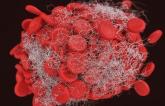 Thrombus on the Watchman LAA Occluder Tied to Higher Stroke Risk
