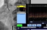 FFR in PCI for Stable CAD: Lasting Benefit Shown by FAME 2, SCAAR Data
