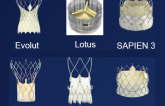 Modern “Era” TAVR with Optimal Technology and Techniques