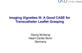 Imaging Vignettes III: A Good CASE for Transcatheter Leaflet Grasping