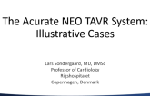 The ACCURATE NEO TAVR System: Illustrative Cases (Eg, Horizontal Aorta)
