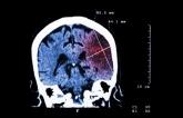 Platelet Reactivity Linked With Ischemic Stroke Risk Post-DES Implantation: ADAPT-DES Substudy