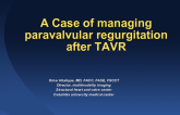 Case Presentation: A Case of Managing Paravalvular Regurgitation During TAVR