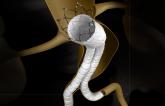 FDA Advisory Panel Gives Thumbs Up to EVAR System