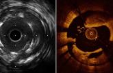OCT, IVUS Each Boost Long-term Outcomes When Used to Guide PCI, Study Suggests