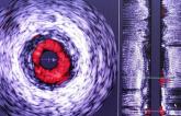 SCAI Updates Statement on Intracoronary Diagnostic Tools