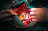 Story 2: STS Data: Mitral Valve Cases Are Fastest-Growing Surgical Intervention in North America