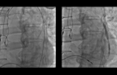 Wire Across: Native Coronary Perforation (Post CABG)
