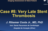 Case #8: Very Late Stent Thrombosis