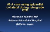Case #5: A Case Using Epicardial Collaterals During Retrograde CTO
