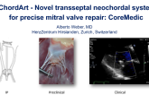 Novel Transseptal Neochordal System for Precise Mitral Valve Repair: Chordart