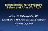 Case #4: Bioprosthetic Valve Fracture - Before or After TAVR ViV?
