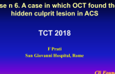 Case #6: A Case in Which OCT “Found” the Hidden Culprit Lesion in ACS