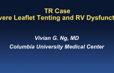 Case Presentation: A TR Case of… Severe Leaflet Tenting and RV Dysfunction