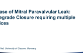 Case #3: A Case of Mitral Paravalvular Leak: Antegrade Closure Requiring Multiple Devices