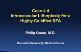 Case #4: Intravascular Lithoplasty for a Highly Calcified SFA