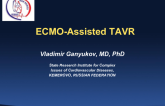 Case Presentation: ECMO-Assisted TAVR