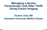 Case #5: Managing a Severe Paravalvular Leak After TAVR Using Fusion Imaging