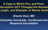 Case #2: A Case in Which Pre- and Post-interventional OCT Changed the Number, Length and/or Diameters of Stents Used
