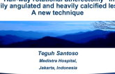 Case #10: From Indonesia: “Half-Way Rotational Atherectomy” in a Heavily Angulated and Heavily Calcified Lesion- A New Technique