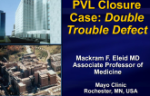 Case #6: Closing Right-Sided Paravalvular Leaks: A Case of Tricuspid PVL Closure