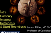 Intravascular Imaging to Evaluate Stent Thrombosis and Restenosis