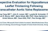 TCT-72: A Prospective Evaluation for Hypoattenuated Leaflet Thickening Following Transcatheter Aortic Valve Replacement