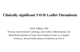 Case #4: Clinically Significant TAVR Leaflet Thrombosis
