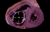 Clips and Rings for Tricuspid Regurgitation: Early Data Speak to Progress and Challenges