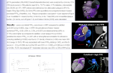 PINNS in the zoom: High risk plaque but not calcified by coronary CTA predict ischemia in non-obstructive lesions