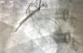 CTO PCI Patients With CKD Have More Acute Kidney Injury but Not Dialysis or TLF Over 2 Years