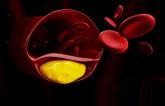 Final Phase III Bempedoic Acid Trial Proves Positive for LDL-Lowering 