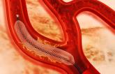 New-Generation DES Better Than Older Stents Over 10 Years, Regardless of Polymer Type