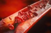 ‘Accelerated Atherosclerosis’ Not Uncommon in Arteries of Young People 