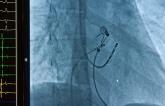 Catheter Ablation Boosts Outcomes in Patients With A-fib and Heart Failure: Meta-analysis