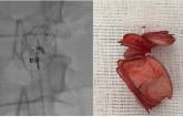 Device Embolization: Tools and Training Essential to Avoid Worst-Case Scenarios  