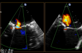 MitraClip Analysis Highlights Questions of Patient Selection in Functional MR
