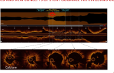 OLD AND NEW CONCEPTS OF STENT GUIDANCE WITH IVUS AND OCT