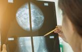 Breast Calcifications May Hold Important Clues for CV Risk Stratification