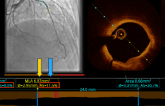 OCT, IVUS, FFR, iFR (NHPR): Which Technology When?