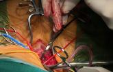 Durability of Surgery, Stenting for Symptomatic Carotid Stenosis Good for Up to a Decade
