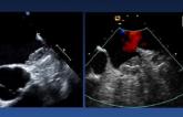 Device-Related Thrombus and LAA Closure: Rare but Dangerous